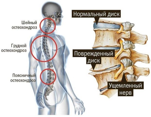 Vertebral cervicalgia. What is it in adults, children, how to treat with muscle-tonic, myofascial, pain syndrome