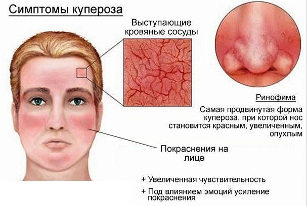 Horiaca tvár: príčiny, kazy a teplo u žien, mužov
