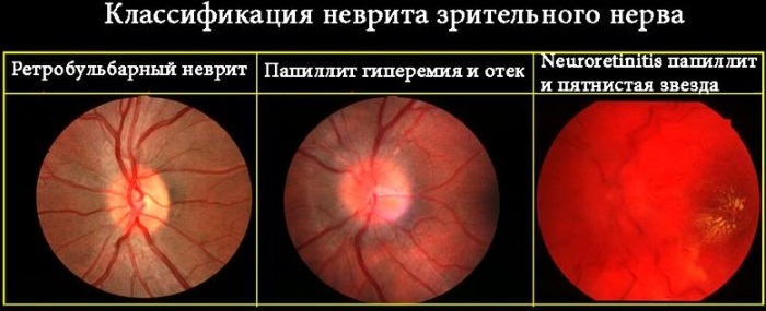 Eyes hurt when moving the eyeballs to the side, up. Reasons, what to do, how to treat