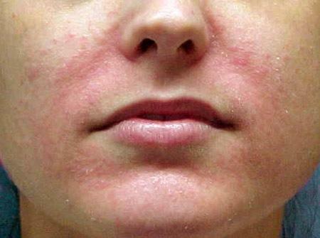 Seborrheic dermatitis on the face
