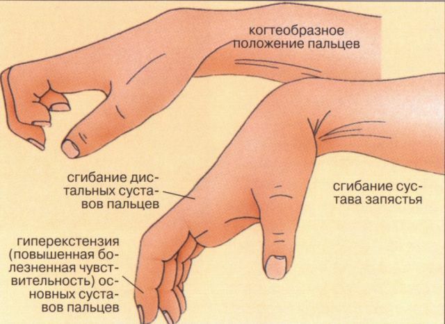 Symptomen van ankylose van de handen