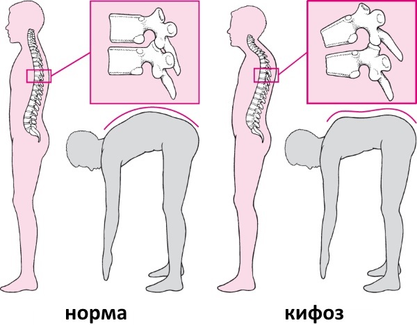 Thoracic kyphosis is enhanced. What does this mean, symptoms, treatment, exercise therapy, exercise