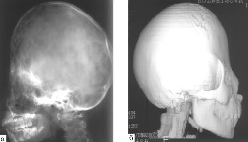 Deformation of the skull in newborns, children, with breech presentation. Signs, symptoms, how to fix