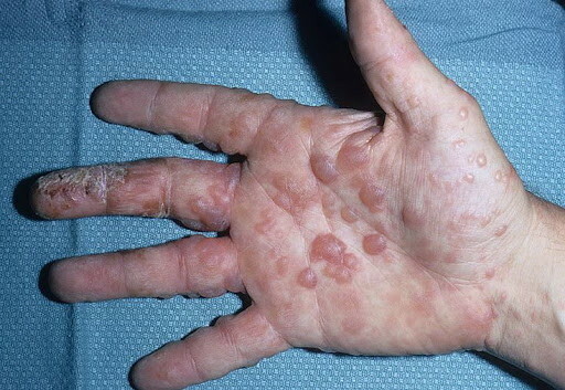 Rote Handflächen eines Kindes, rote Flecken, Punkte. Ursachen