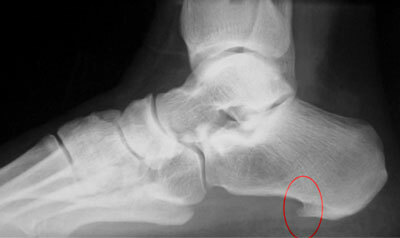 Treatment of pain in the heel
