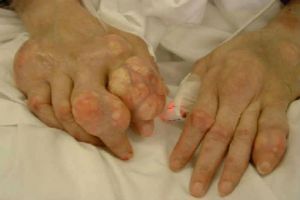Gouty artritida