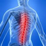 Stenoza canalului spinal