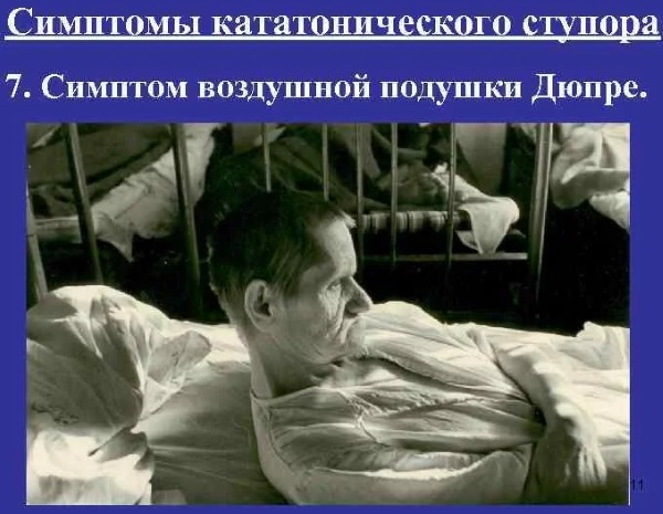 Catatonic stupor. What is it, what is it characterized, treatment, causes