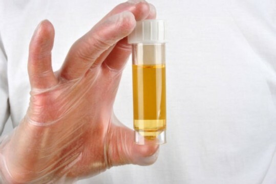 Sugar in the urine of pregnant women