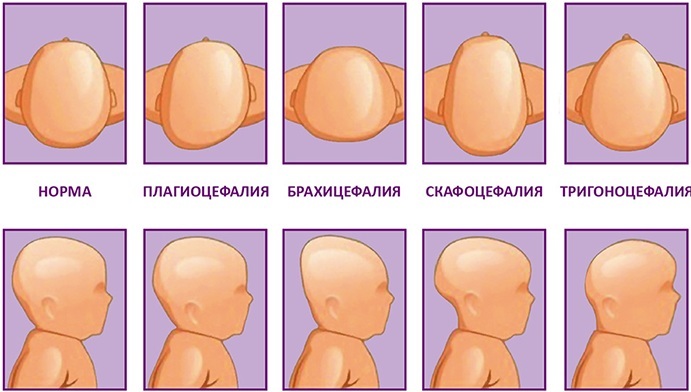 Kraniostenozė (craniosinostozė) vaikams ir suaugusiems. Kas tai yra, simptomai, klinikinės gairės