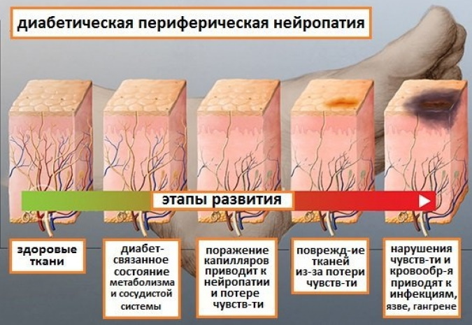 Inflamación del nervio en la pierna, pie. Síntomas y tratamiento