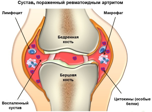 Rheumatoid arthritis. Diagnosis of blood, etiology, pathogenesis, causes, symptoms and treatment