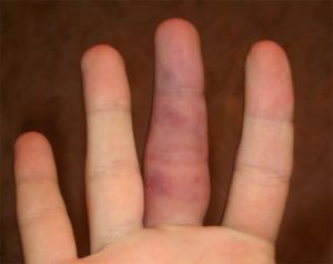 Injury of the finger