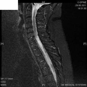 MRI of the spinal cord