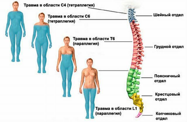 les niveaux de blessure au dos en cas de blessure