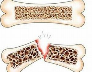 Osteoporose av bein