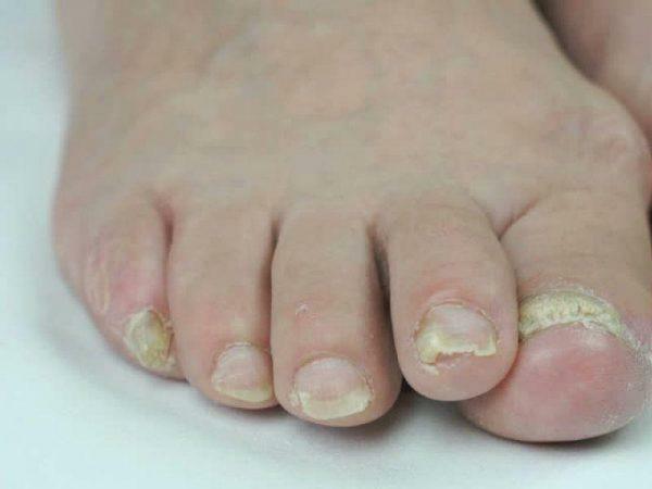 Onychomycosis od noktiju