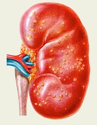 Inflammation of the kidney