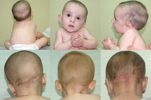 Torticollis bij zuigelingen 2-3-4-6 maanden. Symptomen, foto's, behandeling