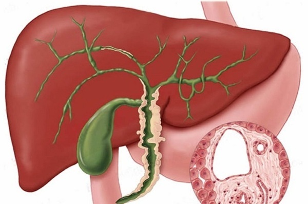 Cholangitis. Symptoms and treatment in adults, what is it