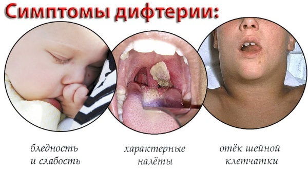 Diphtheria in children. Symptoms, prevention, transmission, treatment