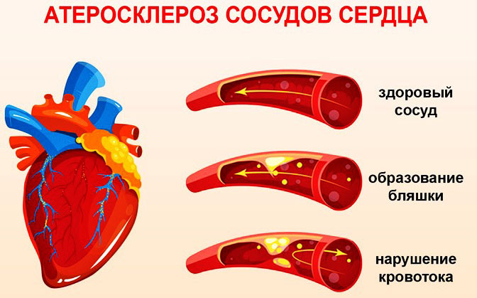 Atherosclerosis of the vessels of the heart. Symptoms and treatment in the elderly, causes