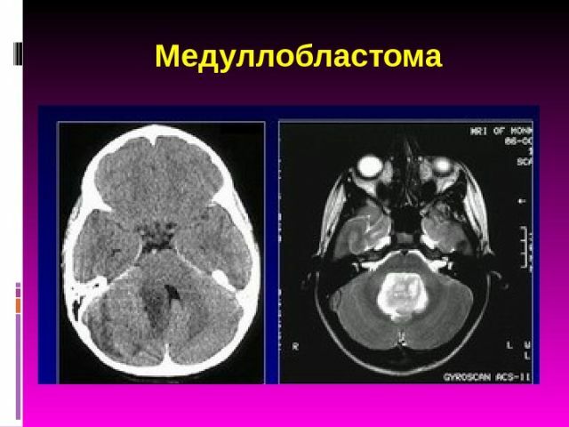 meduloblastómový cerebelum MRI
