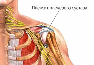 plexitis of the shoulder