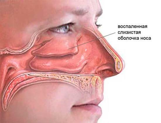 Nasal membranes with runny nose