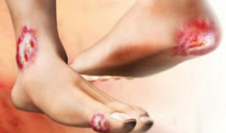 Prevention of complications - the risk of developing a diabetic foot syndrome