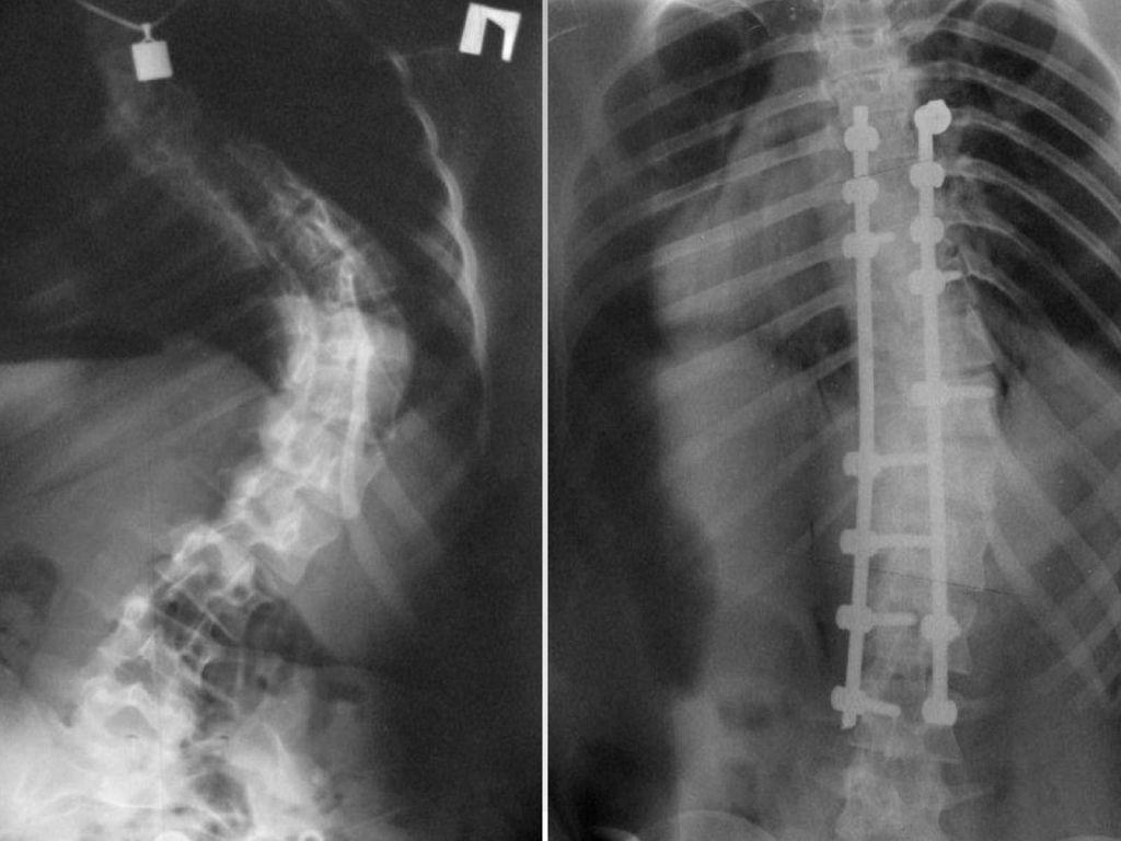 Selkärangan röntgen ennen hoitoa ja sen jälkeen