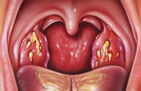 Dolor de garganta folicular