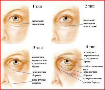 Types of hernia under the eyes