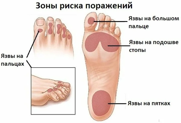 Diabetische voet. Behandeling, medicijnen, zalven, preventie, voetverzorging