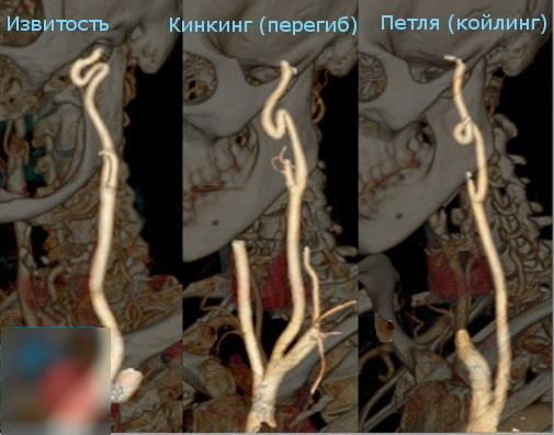 Coiling of the internal carotid artery. Danger what it is