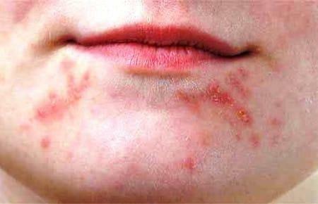 Rashes may be the result of taking medications