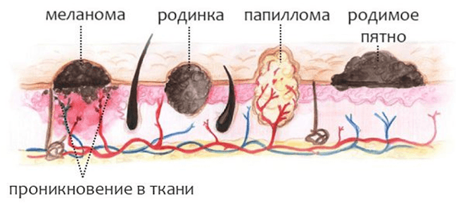 Perbedaan tanda lahir dari papiloma