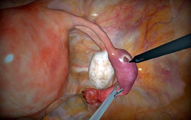 Ectopic( ectopic) nėštumas, chirurginis gydymas