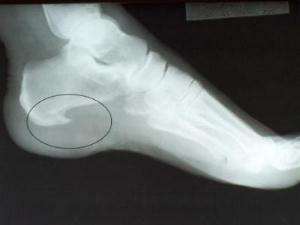 x-ray of the heel spur