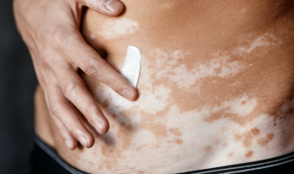 Vitiligo gydymas: vaistai, vitaminai, tepalai, UV lempa, lazeris. Atsiliepimai