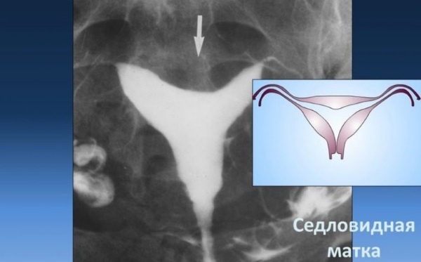 Saddle uterus. What is it, what does it mean during pregnancy, treatment