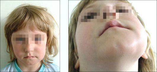 Acute periostitis of the lower jaw in children