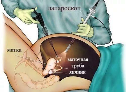 Surgical removal of the ovarian cyst