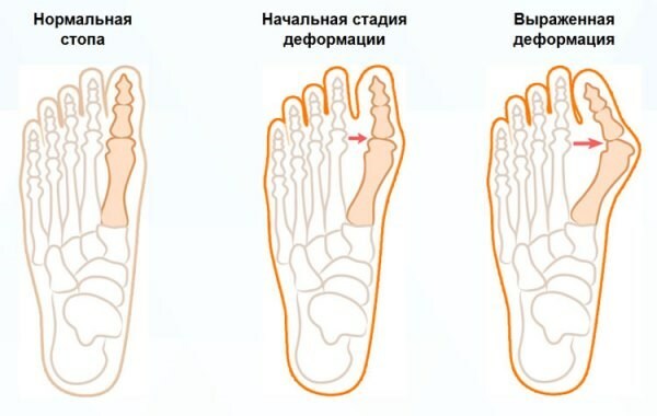 Årsagerne til hæl smerte ben mens du går, smertefuld Step. Sådan behandler, folkemusik retsmidler