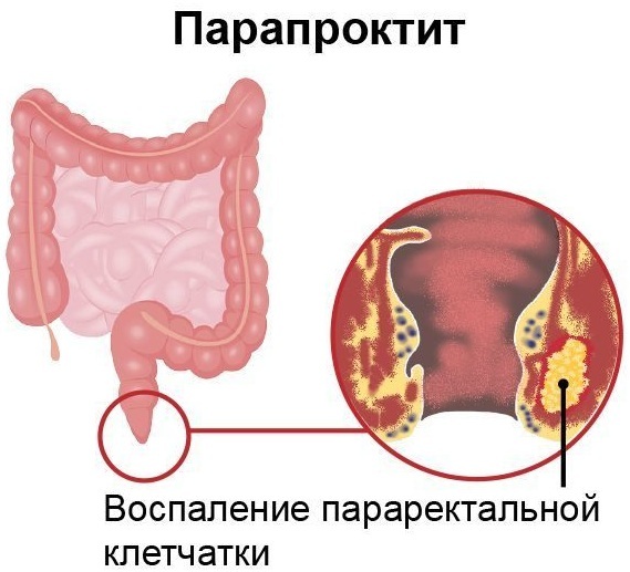 Paraproctite. Classification de localisation, clinique, traitement