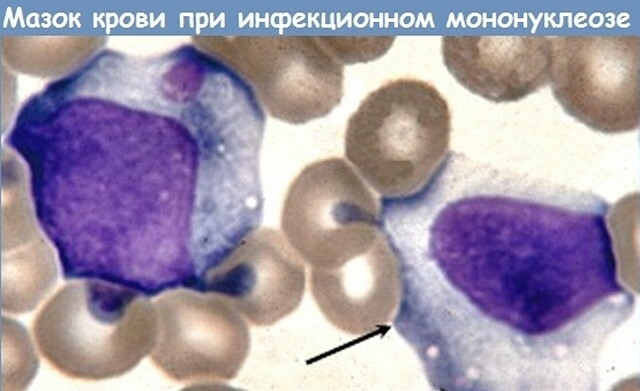 Atypical lymphocytes in a child's blood test. What does it mean
