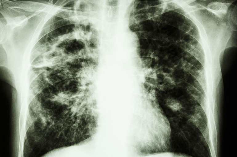 Sorte tuberkuloma