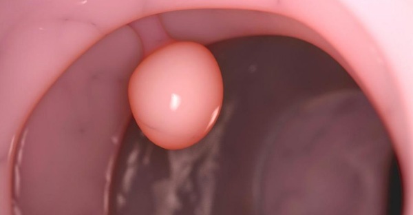 Polyp in the cervical canal. Whether it is possible to conceive, treatment, bleeding during pregnancy, surgery, removal, curettage