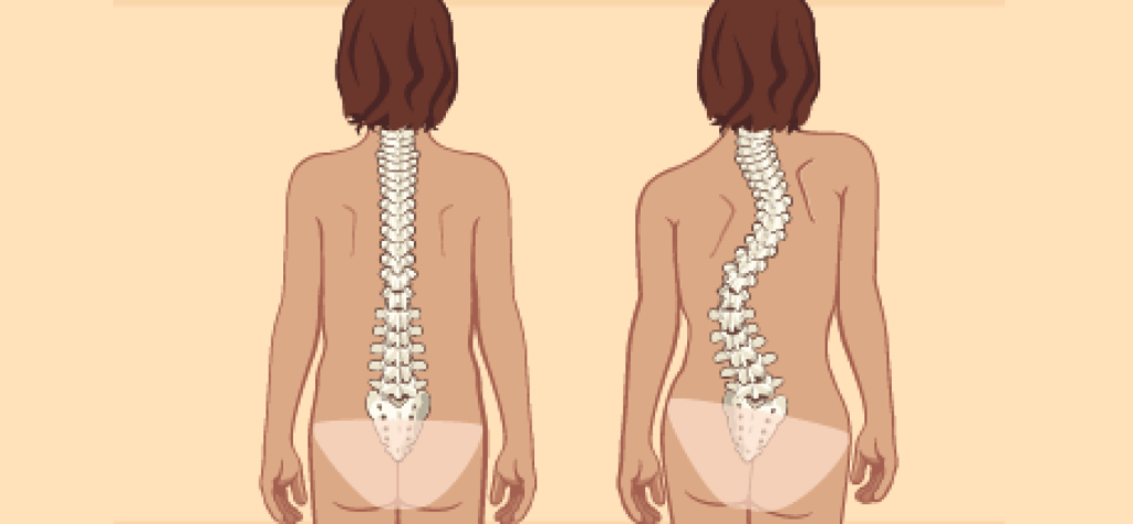 How to get rid of scoliosis - conservative and surgical treatment, prevention!