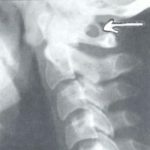 anomalia da primeira vértebra cervical